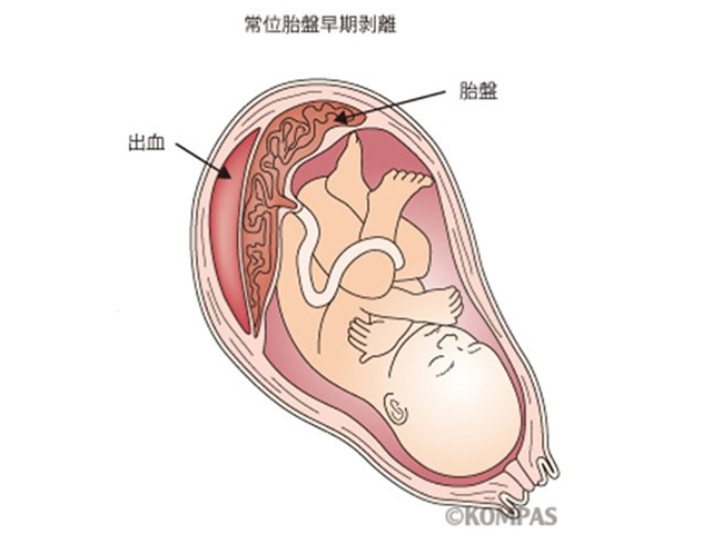 常位胎盤早期剥離