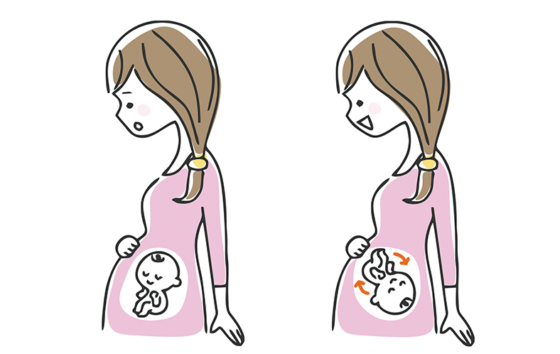 36週をすぎても逆子のままだったら、どうしたらいいの?